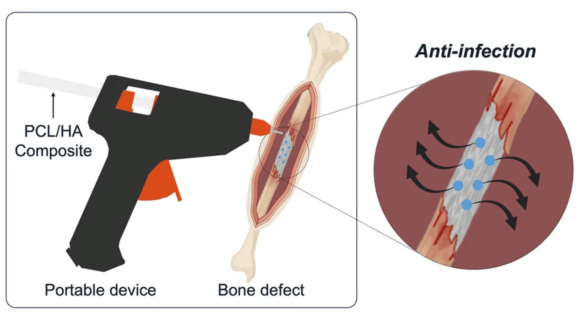A team of researchers has modified a glue gun to print bone-like material directly onto a fracture. (Image credit: Device : Jeon et al. CC BY-SA)
