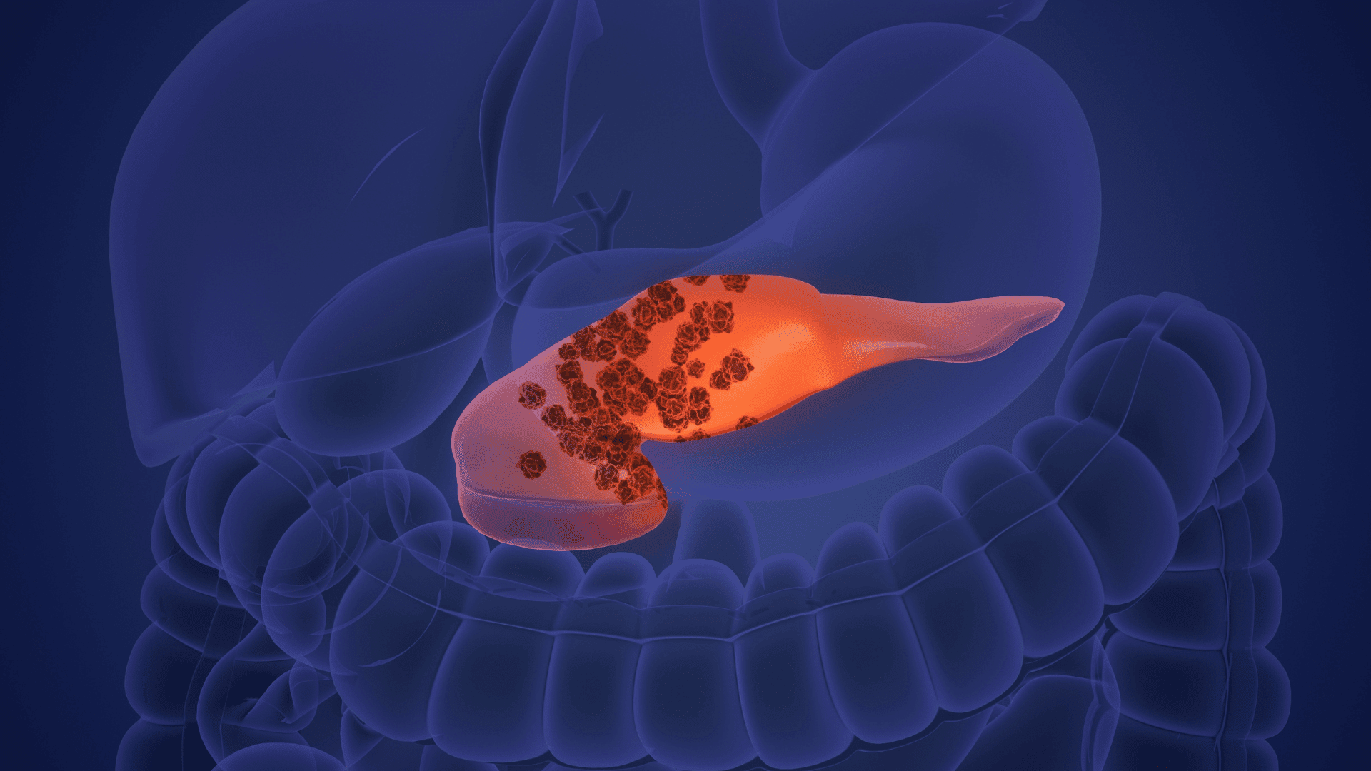 pancreatic cancer detection