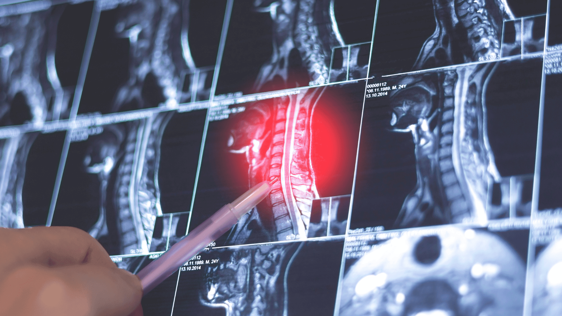 head and neck cancer