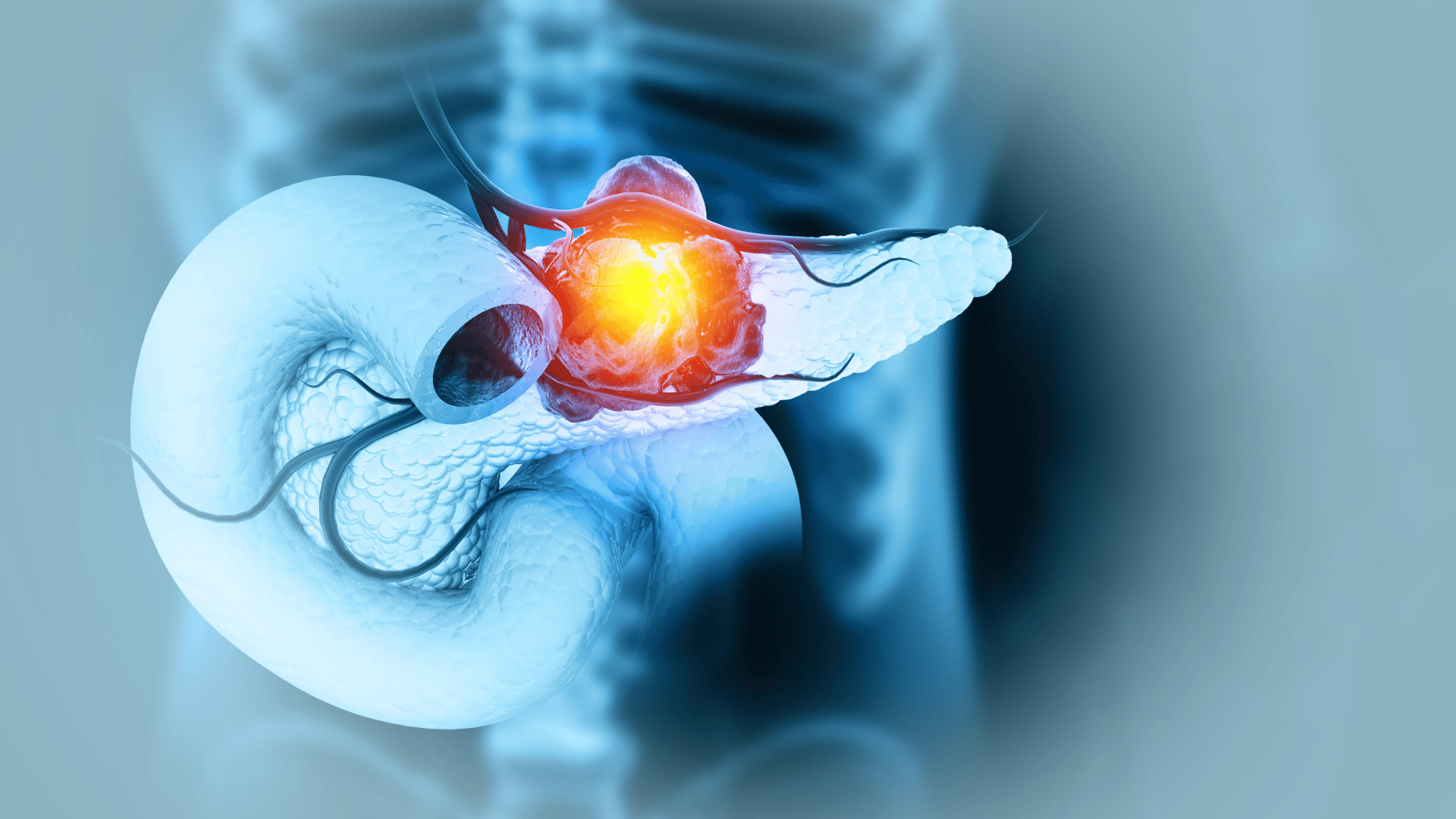 pancreatic cancer pancreatic cancer